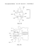 PERCUTANEOUS SPINAL IMPLANTS AND METHODS diagram and image