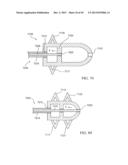 PERCUTANEOUS SPINAL IMPLANTS AND METHODS diagram and image