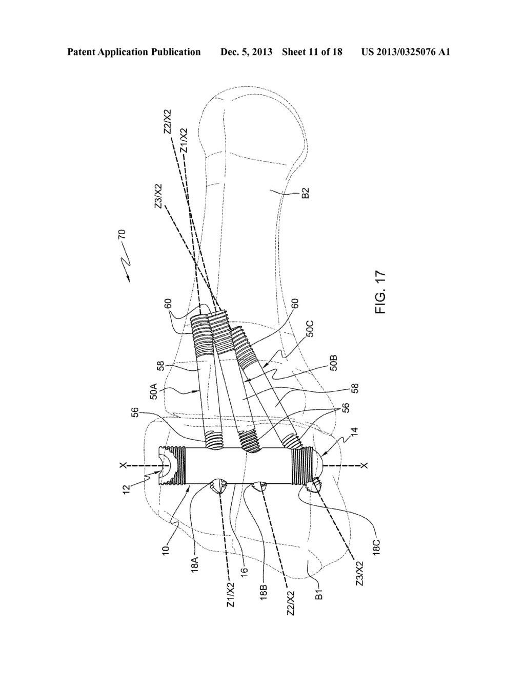 LOWER EXTREMITY FUSION DEVICES AND METHODS - diagram, schematic, and image 12