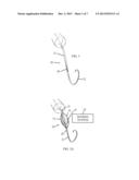 PERCUTANEOUS POSITIONING DEVICE diagram and image