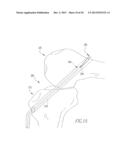 HELICOIL INTERFERENCE FIXATION SYSTEM FOR ATTACHING A GRAFT LIGAMENT TO A     BONE diagram and image