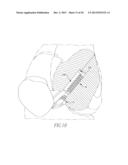 HELICOIL INTERFERENCE FIXATION SYSTEM FOR ATTACHING A GRAFT LIGAMENT TO A     BONE diagram and image