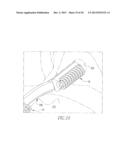 HELICOIL INTERFERENCE FIXATION SYSTEM FOR ATTACHING A GRAFT LIGAMENT TO A     BONE diagram and image