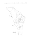 HELICOIL INTERFERENCE FIXATION SYSTEM FOR ATTACHING A GRAFT LIGAMENT TO A     BONE diagram and image