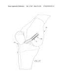 HELICOIL INTERFERENCE FIXATION SYSTEM FOR ATTACHING A GRAFT LIGAMENT TO A     BONE diagram and image