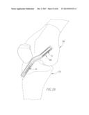 HELICOIL INTERFERENCE FIXATION SYSTEM FOR ATTACHING A GRAFT LIGAMENT TO A     BONE diagram and image