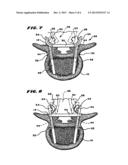 Facet Arthoplasty Devices and Methods diagram and image