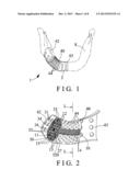 TEXTURED IMPLANT DEVICE diagram and image