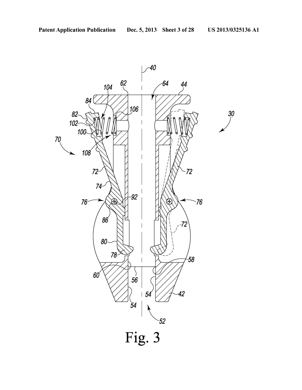 TIBIAL TRIAL INSTRUMENTS AND METHOD OF USING SAME - diagram, schematic, and image 04