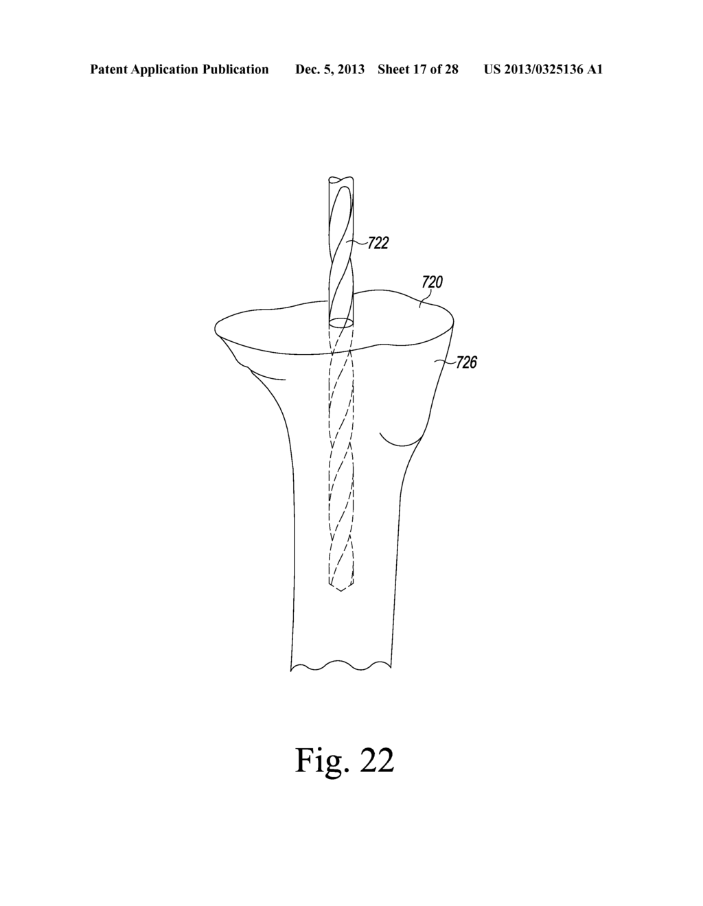 TIBIAL TRIAL INSTRUMENTS AND METHOD OF USING SAME - diagram, schematic, and image 18