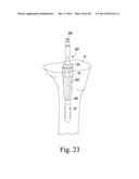 TIBIAL TRIAL INSTRUMENTS AND METHOD OF USING SAME diagram and image