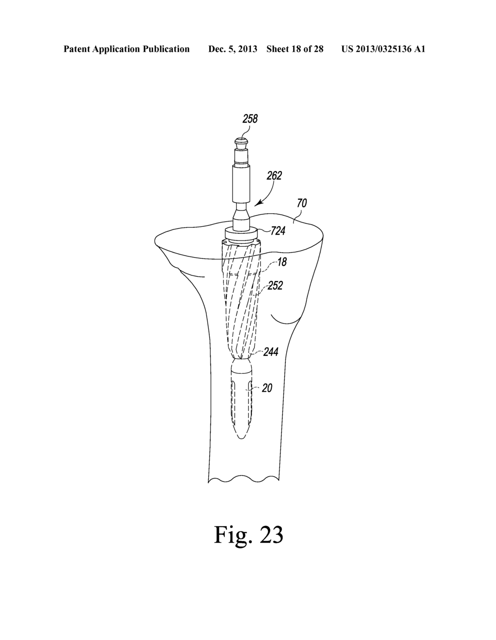 TIBIAL TRIAL INSTRUMENTS AND METHOD OF USING SAME - diagram, schematic, and image 19