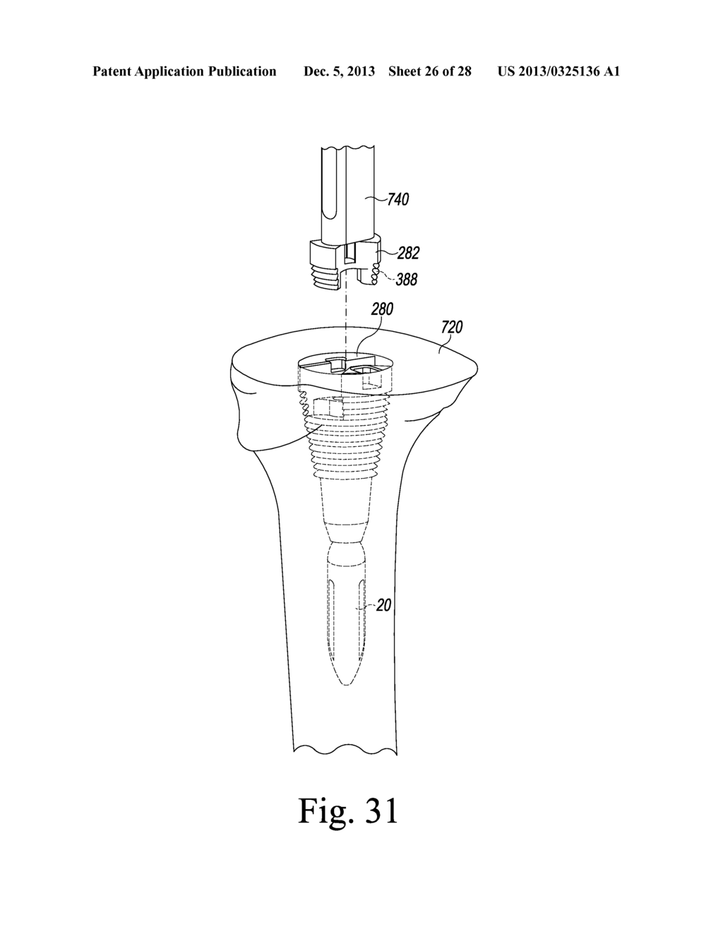 TIBIAL TRIAL INSTRUMENTS AND METHOD OF USING SAME - diagram, schematic, and image 27