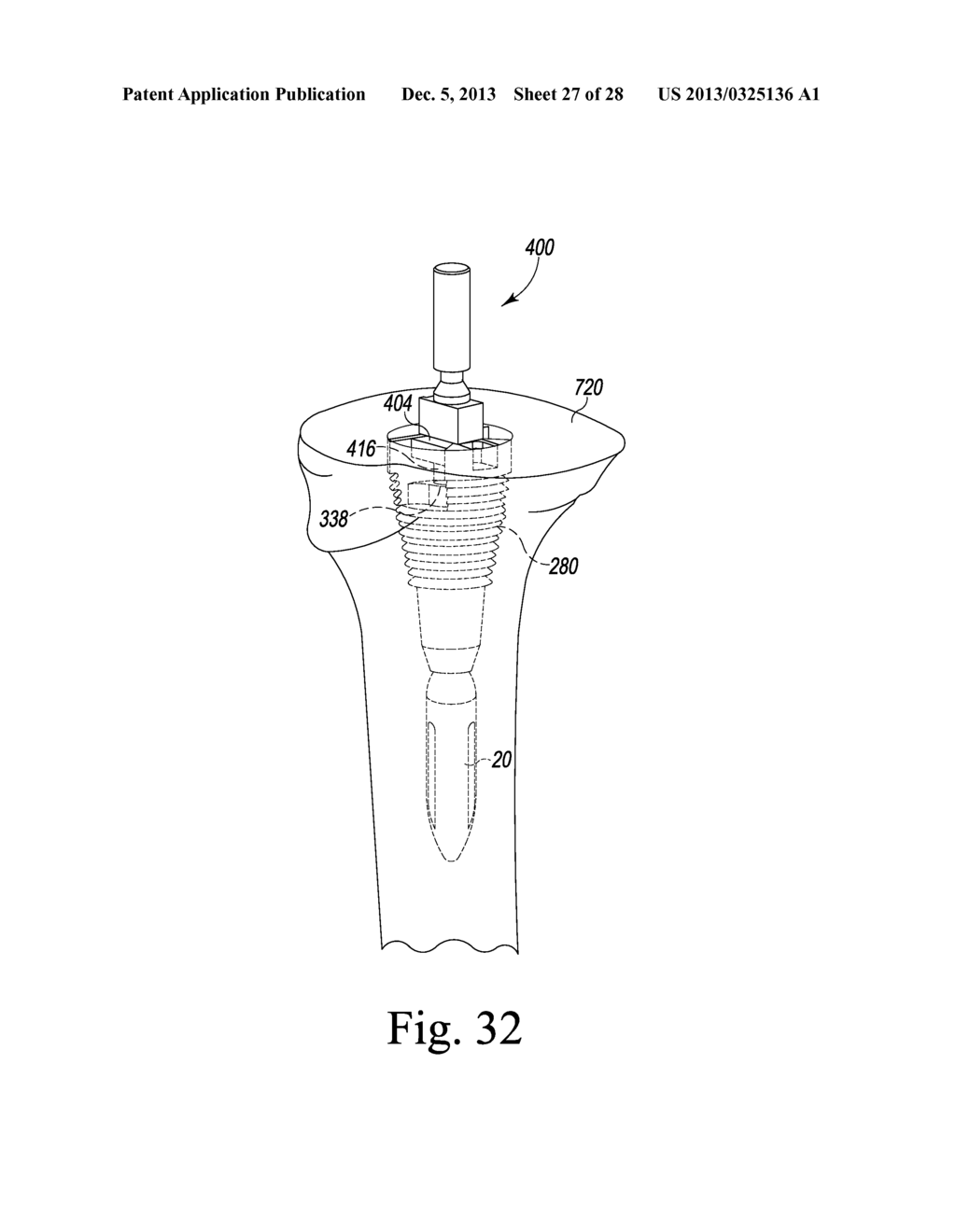 TIBIAL TRIAL INSTRUMENTS AND METHOD OF USING SAME - diagram, schematic, and image 28