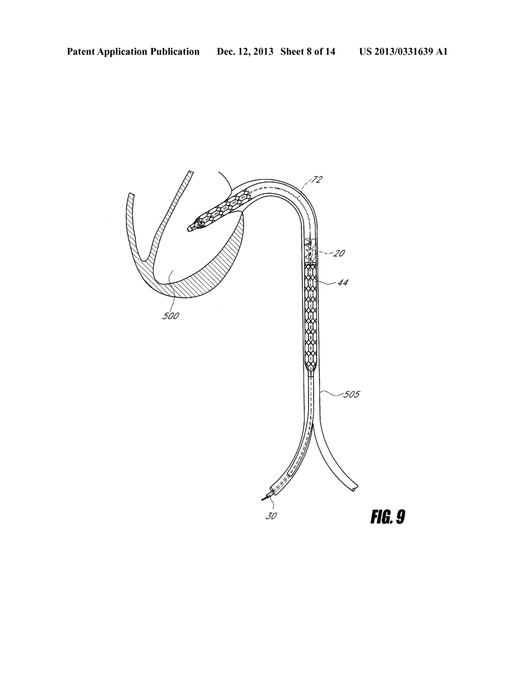 BLOOD PUMP WITH EXPANDABLE CANNULA - diagram, schematic, and image 09