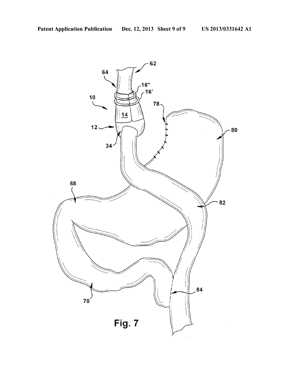 PREFORMED GASTRIC BAND AND METHOD OF USE - diagram, schematic, and image 10