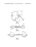 Recovery Catheter Assembly and Method diagram and image