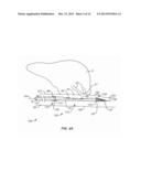 Recovery Catheter Assembly and Method diagram and image