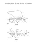 Recovery Catheter Assembly and Method diagram and image