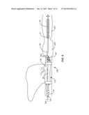 Recovery Catheter Assembly and Method diagram and image