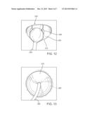 Method and Device for Percutaneous Valve Annuloplasty diagram and image