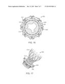 Method and Device for Percutaneous Valve Annuloplasty diagram and image