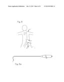 Method of Implanting a PFO Occluder in a Patient diagram and image