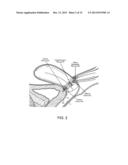 DEVICES AND METHODS FOR STIMULATING NERVES diagram and image