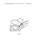 DEVICES AND METHODS FOR STIMULATING NERVES diagram and image