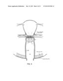 DEVICES AND METHODS FOR STIMULATING NERVES diagram and image