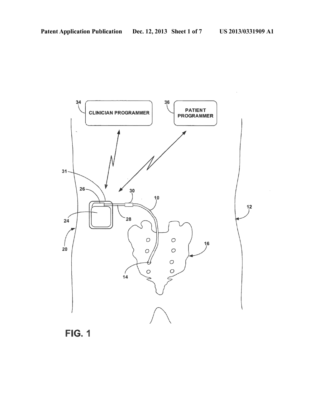 IMPLANTABLE NEUROSTIMULATOR SUPPORTING TRIAL AND CHRONIC MODES - diagram, schematic, and image 02