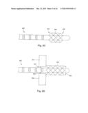 ANCHORING UNITS FOR LEADS OF IMPLANTABLE ELECTRIC STIMULATION SYSTEMS AND     METHODS OF MAKING AND USING diagram and image