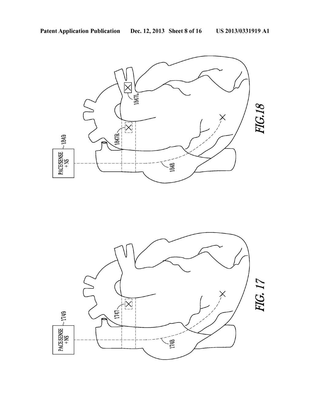 SYSTEM FOR STIMULATING AUTONOMIC TARGETS FROM PULMONARY ARTERY - diagram, schematic, and image 09