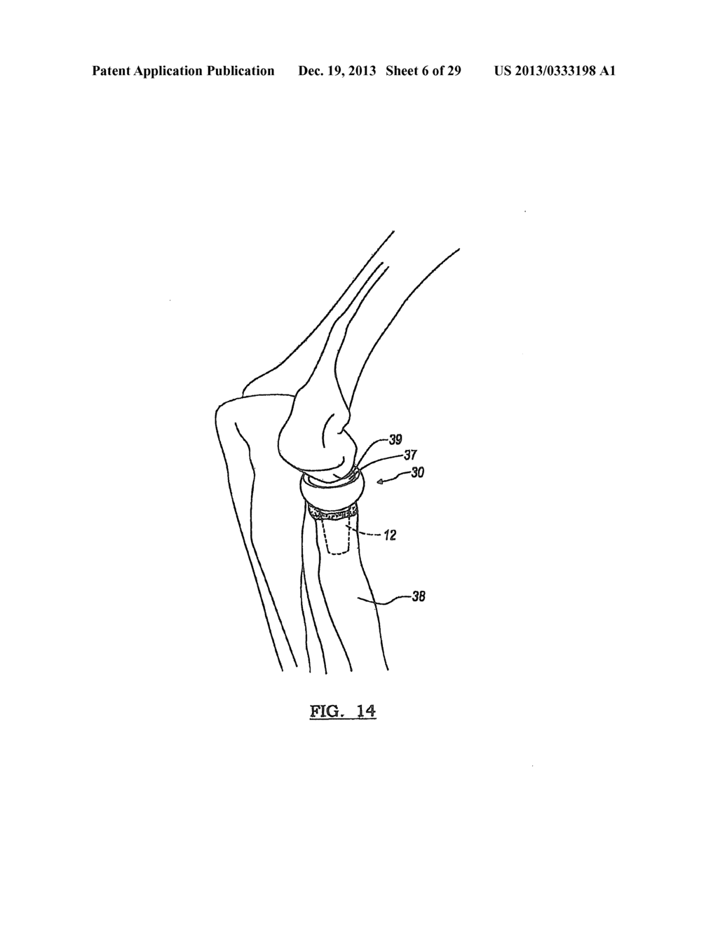 MODULAR RADIAL HEAD PROSTHESIS - diagram, schematic, and image 07