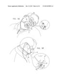 ENDOSCOPIC BITE BLOCK diagram and image