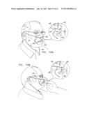 ENDOSCOPIC BITE BLOCK diagram and image