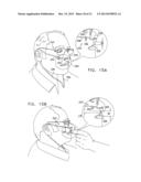 ENDOSCOPIC BITE BLOCK diagram and image