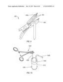 TISSUE EXTRACTION DEVICE diagram and image