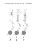 IMPLANTABLE FLUID MANAGEMENT SYSTEM FOR THE REMOVAL OF EXCESS FLUID diagram and image