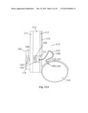 IMPLANTABLE FLUID MANAGEMENT SYSTEM FOR THE REMOVAL OF EXCESS FLUID diagram and image