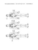 IMPLANTABLE FLUID MANAGEMENT SYSTEM FOR THE REMOVAL OF EXCESS FLUID diagram and image