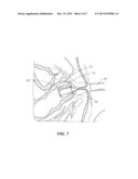 Soluble Material Insertion Aid and Method for Inserting a Balloon Catheter diagram and image