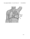 GROOVED CHEST TUBE diagram and image