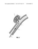DETACHABLE COUPLING FOR CATHETER diagram and image
