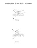 Ablation catheter electrode having multiple thermal sensors and method of     use diagram and image