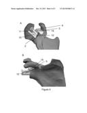 SHOULDER BASE PLATE COVERAGE AND STABILITY diagram and image