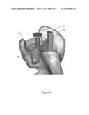 SHOULDER BASE PLATE COVERAGE AND STABILITY diagram and image