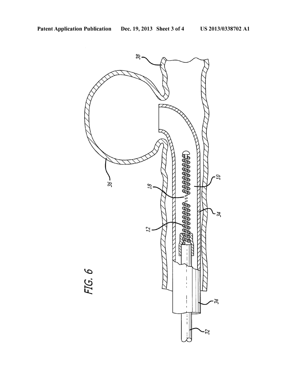 VASOOCCLUSIVE COIL WITH BIPLEX WINDINGS TO IMPROVE MECHANICAL PROPERTIES - diagram, schematic, and image 04