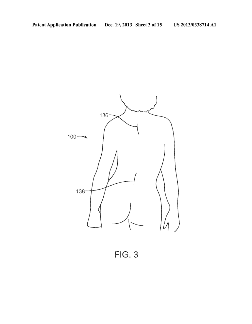 MAGNETIC IMPLANTS WITH IMPROVED ANATOMICAL COMPATIBILITY - diagram, schematic, and image 04