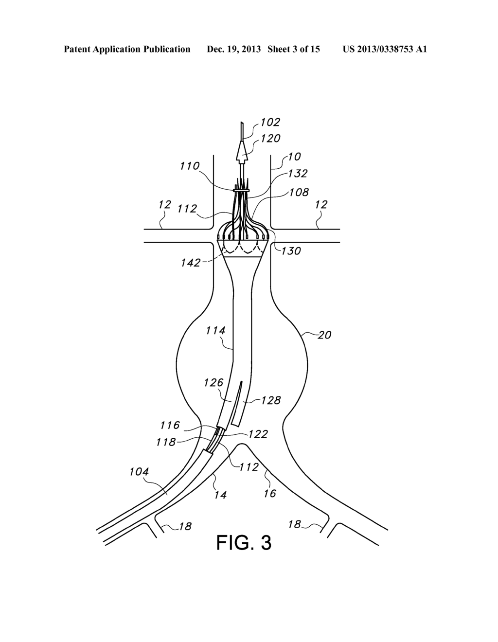 ENDOVASCULAR DELIVERY SYSTEM WITH FLEXIBLE AND TORQUEABLE HYPOTUBE - diagram, schematic, and image 04